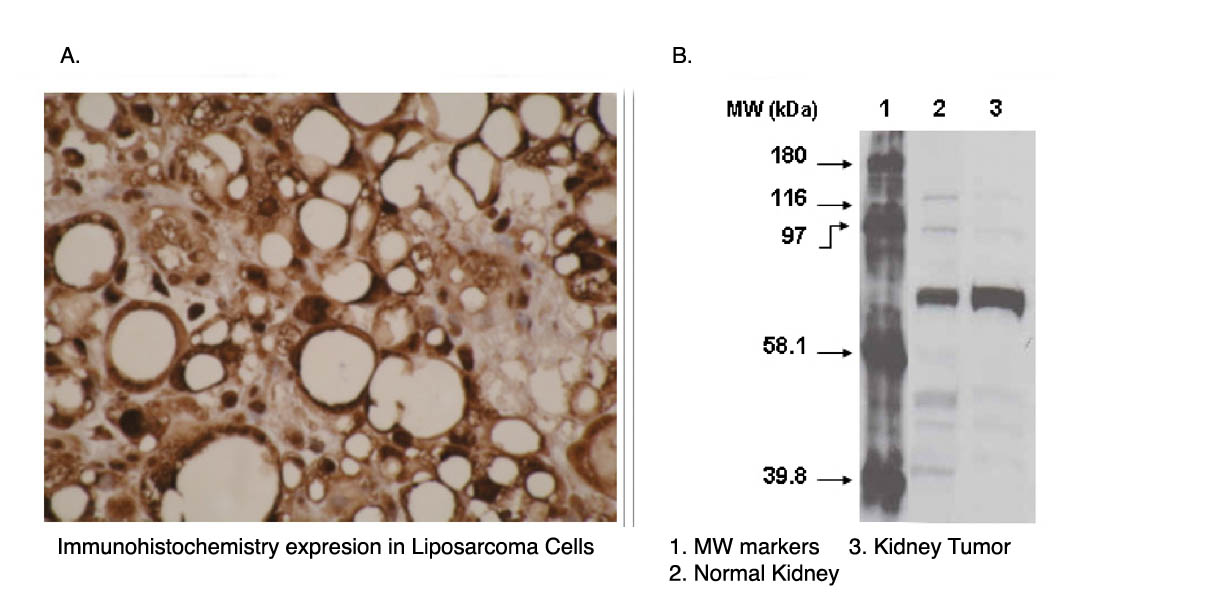 "
A. Immunohistochemical staining of human liposarcoma cells using CYP4F11 antibody (Cat. No. X2052M).
B. Western blot using CYP4F11 antibody one normal (2) and cancerous (3) kidney cell lysates."